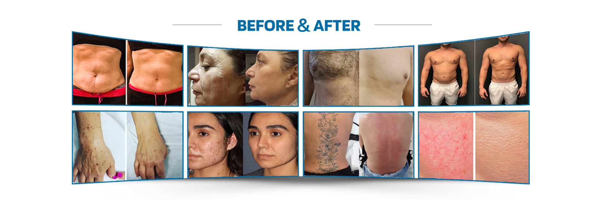 качество Машина удаления волос лазера завод